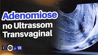 ADENOMIOSE - COMO RECONHECER NO ULTRASSOM TRANSVAGINAL I DR. MICHEL PALHETA I VOCÊ RADIOLOGISTA