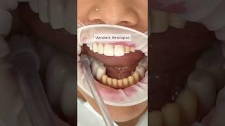Veneers Placement Timelapse: Watch This Step-by-Step Guide for a Perfect Smile #shorts #Timelapse