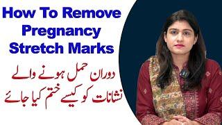 How To remove Pregnancy Stretch Marks