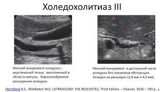 Эхосемиотика структурных изменений желчного пузыря и желчных путей. Часть 2.