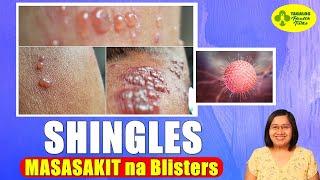 MASAKIT na Blisters Dulot ng SHINGLES ~ Varicella Zoster Virus - Tagalog Health Tips | Nurse Dianne