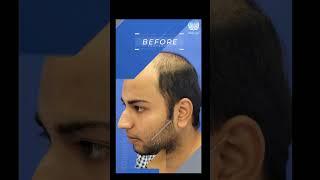 MedLinks Hair Transplant Results | Before After Results #shortsfeed #shorts #medlinks