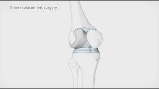 How is a knee replacement performed | Spire Healthcare