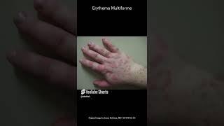 Erythema Multiforme