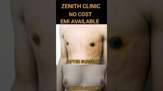 gynecomastia surgery Ahmedabad jaipur jamnagar junagarh Gandhidham morbi Rajkot bhuj Bharuch baroda