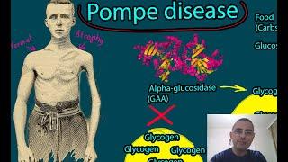 Pompe disease - Symptoms, Causes, Treatment Prognosis