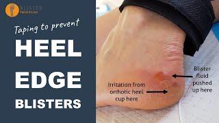 Taping To Prevent Heel Edge Blisters | Blister Prevention