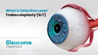 What is Selective Laser Trabeculoplasty (SLT) | Glaucoma Treatment (3D)