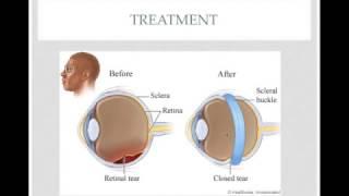 Retinal Detachment Explained  -- Quick review