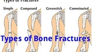 Types of Bone Fractures (Examville com Quick Review)