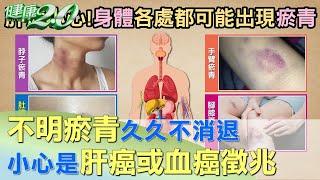 不明瘀青久久不消退 小心是肝癌或血癌徵兆 健康2.0