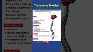 Transverse Myelitis |Myelitis |Inflammation of Spinal Cord #myelitis #transversemyelitis