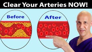 Eat These Foods to Clear Arteries FAST (Stop Heart Attacks & Strokes)  Dr. Mandell