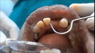 Single visit fibre reinforcement using Ribbond