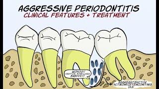 Aggressive Periodontitis (Part 2) - Clinical features and treatment