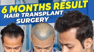 Hair Transplant in Dubai | Best Results & Cost of Hair Transplant in Dubai