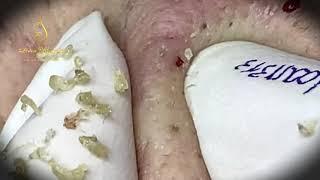 Best blackheads removal (313-1) | Loan Nguyen