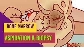 Bone marrow aspiration and biopsy/Process/Indications/Medschool simplified