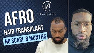 Afro Hair Transplant Results in Turkey 8 Months | Heva Clinic