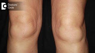 What are the causes of swelling in knees? - Dr.Nagesh HS