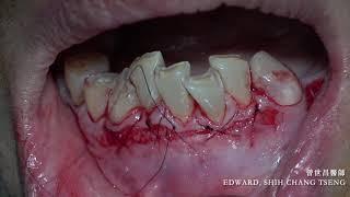 Apicically repositioned flap ( APF) with labial strip free gingival graft(FGG)