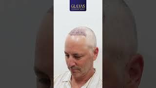 𝐇𝐚𝐢𝐫 𝐓𝐫𝐚𝐧𝐬𝐩𝐥𝐚𝐧𝐭 Malaysia | Lowering Hairline: From Melbourne to KL!