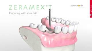 ZERAMEX®T Ceramic Implant Surgery Simulation