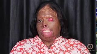 World's Biggest Makeup Transformation Of Acid Attack Victim By India's Transformaton Guru BIJAL GADA