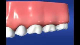 Endodontic Therapy (Root Canal)