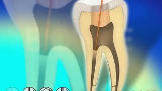 Endodontic Root Canal Disinfection - Waterlase Laser Dentistry