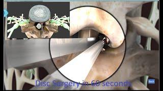 Disc Surgery in 60 seconds