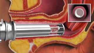 RejuVAnate CO2 Laser: Innovative Non-Surgical Vaginal Rejuvenation Laser Treatment | Dr. Gallus