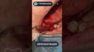Имплантация зубов пациенту. Подвижный мост №1