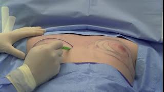Gynecomastia Surgery (Male Breast Reduction) - Dr. Caridi - Austin Gynecomastia Center