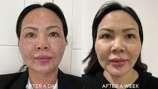 Skin Resurfacing Treatments using iPixel by Harmony