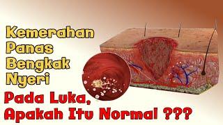 Tahapan/Proses Penyembuhan luka #woundhealing