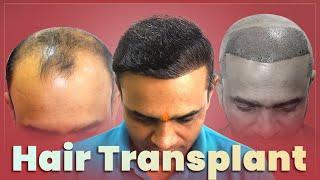 See the Change: Before & After 2 Hair Transplant Sessions  | New Roots | Vashi