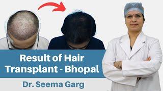 Indore Best Hair Transplant Clinic | Hair Transplant in Indore, Bhopal | Dr. Seema Garg