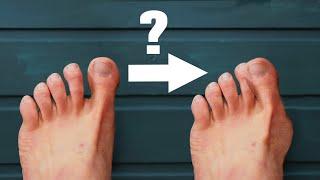 Hallux Valgus - The REAL CAUSE