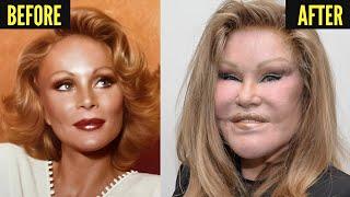 20 Famous Celebrities Who Ruined Their Faces with Plastic Surgery!