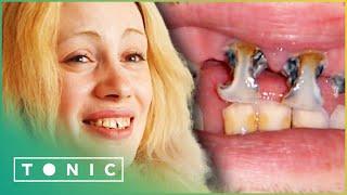 Decaying Teeth Need Medical Care | Britain's Worst Teeth | Tonic