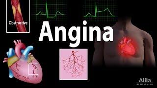 Angina: Stable, Unstable, Microvascular and Prinzmetal, Animation