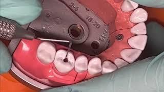 Adex molar endodontic access tooth #14