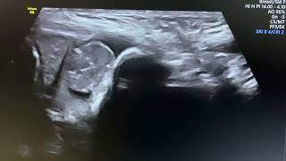 Ultrasound of patent porcessus vaginalis , communicating hyrocele in 3 year boy