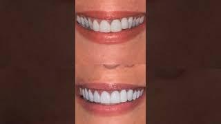 Micro Content Before & After Smile Makeover