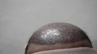 Hair Transplant in india