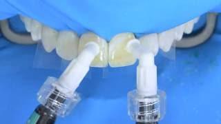 Fluorosis treatment using Icon infiltration, step by step