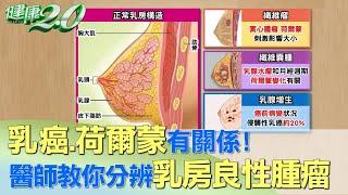 乳癌、荷爾蒙有關係！ 醫師教你分辨乳房良性腫瘤 健康2.0