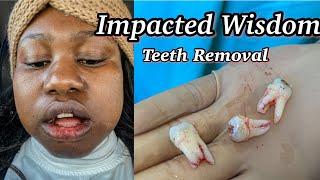 Impacted Wisdom Teeth Removal |Day to Day Recovery and what I ate