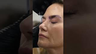 ⭐️ Female Eyebrow Transplant | Smile Hair Clinic ⭐️